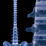 scoliosis_surgery