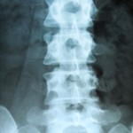 spinal stenosis bone condition 