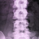 spine fusion surgery 