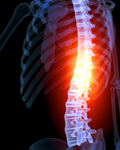 Spondylitis Ribs Spondylitis | New Jersey Spine Specialists